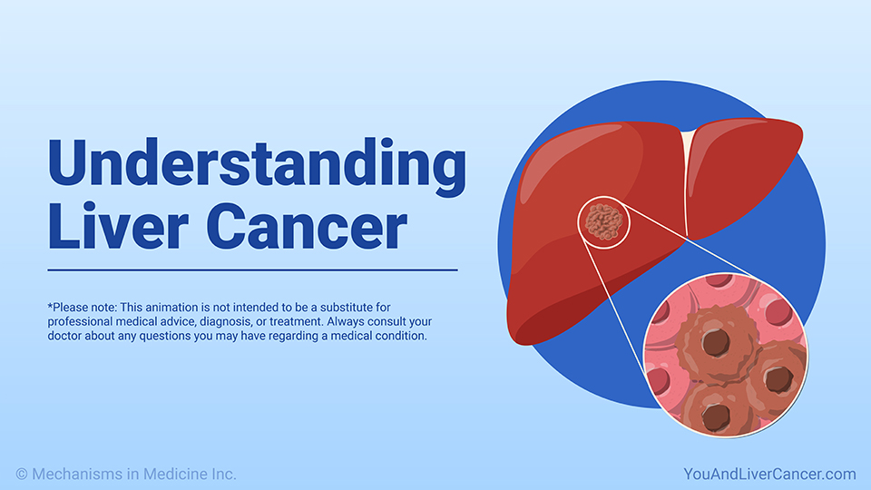 Understanding Liver Cancer — Animation