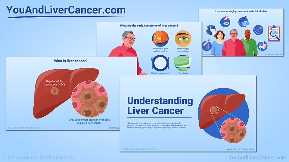 Understanding Liver Cancer — Slide Show