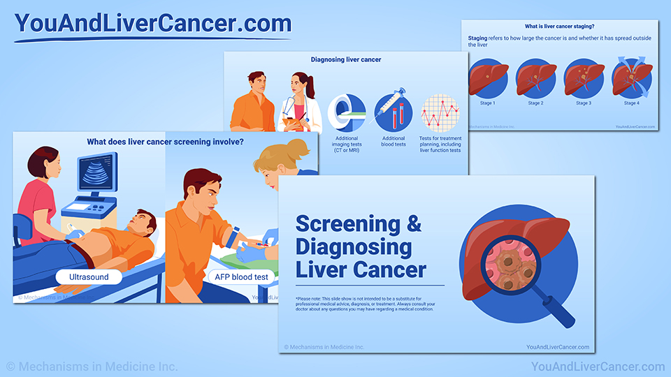 Screening and Diagnosing Liver Cancer — Slide Show