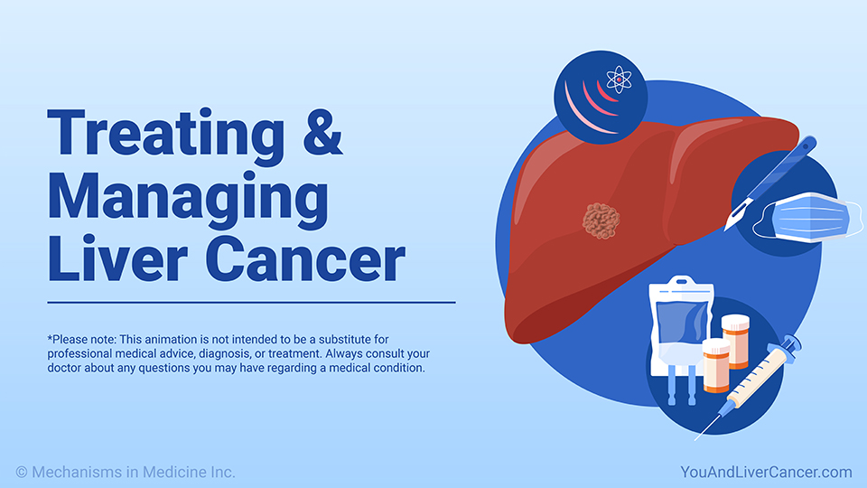 Treating and Managing Liver Cancer — Animation