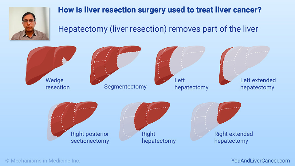 How is liver resection surgery used to treat liver cancer?