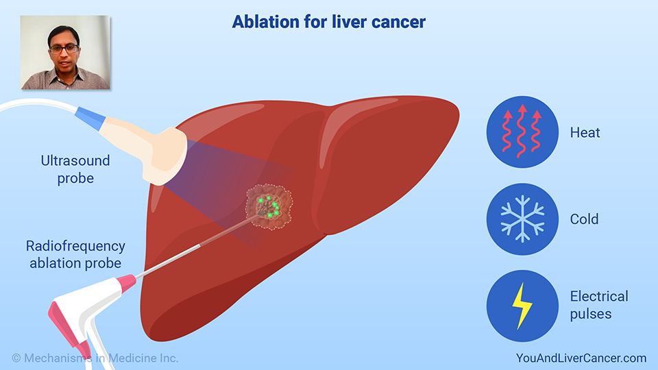 How is ablation used to treat liver cancer?