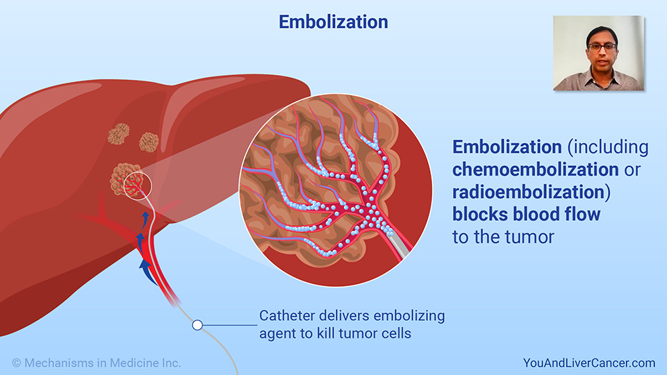How is embolization used to treat liver cancer?