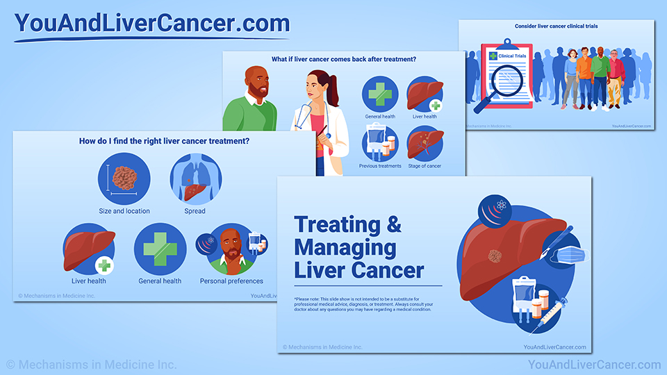 Treating and Managing Liver Cancer — Slide Show