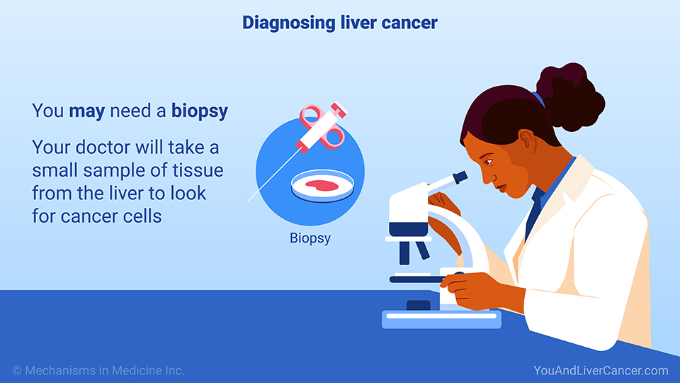 Diagnosing liver cancer