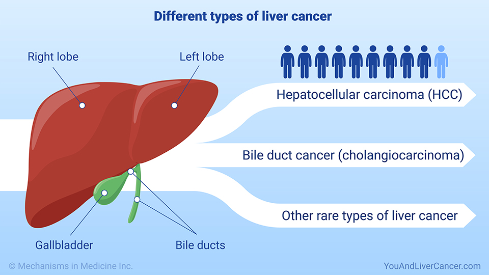 Different types of liver cancer 