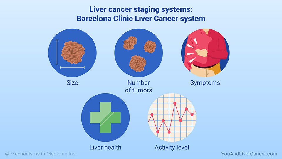 Liver cancer staging systems: Barcelona Clinic Liver Cancer system