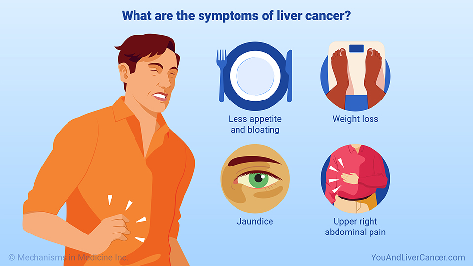 What are the symptoms of liver cancer?