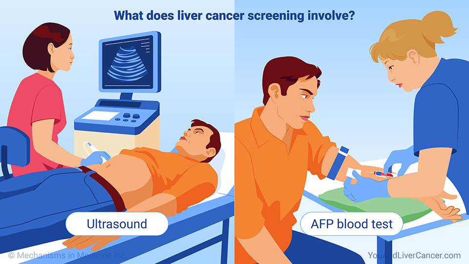 What does liver cancer screening involve?