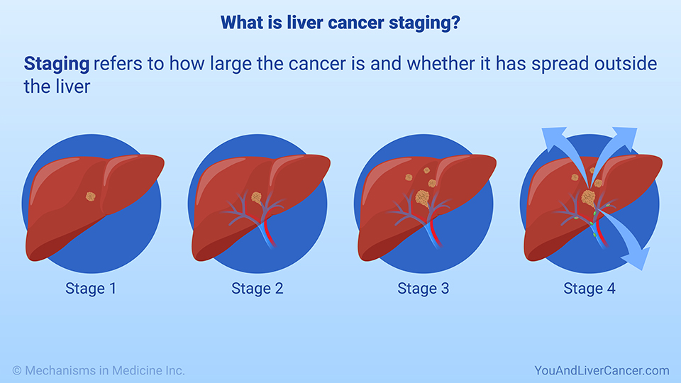 What is liver cancer staging?