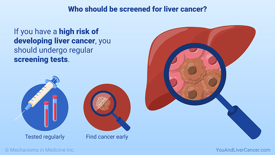 Who should be screened for liver cancer?