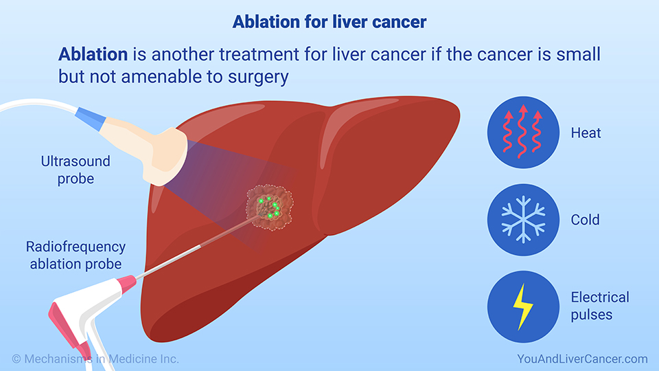 Ablation for liver cancer