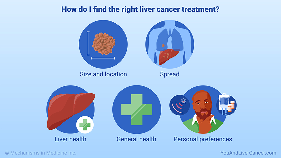 How do I find the right liver cancer treatment?