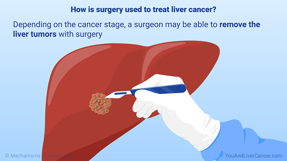 How is surgery used to treat liver cancer?