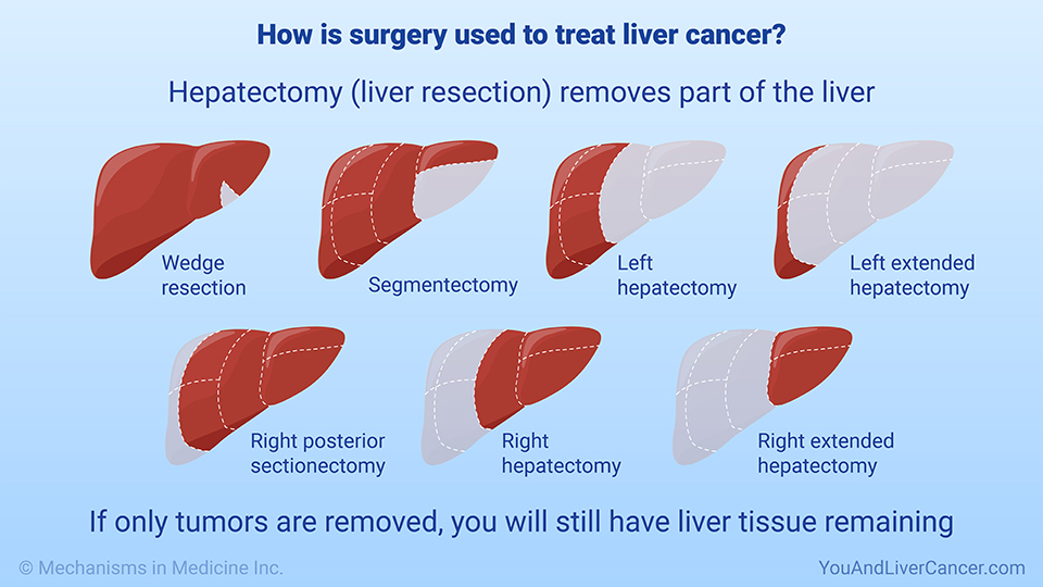 How is surgery used to treat liver cancer?