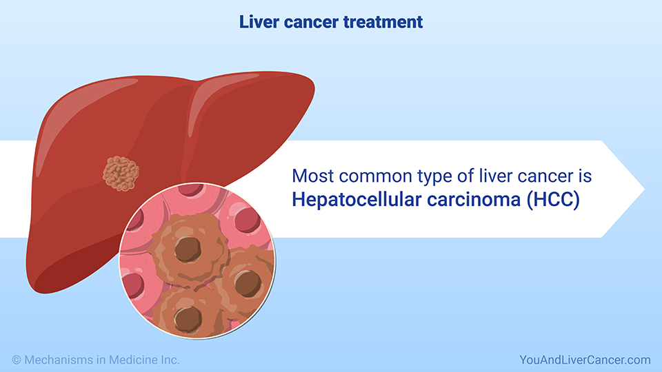 Liver cancer treatment 