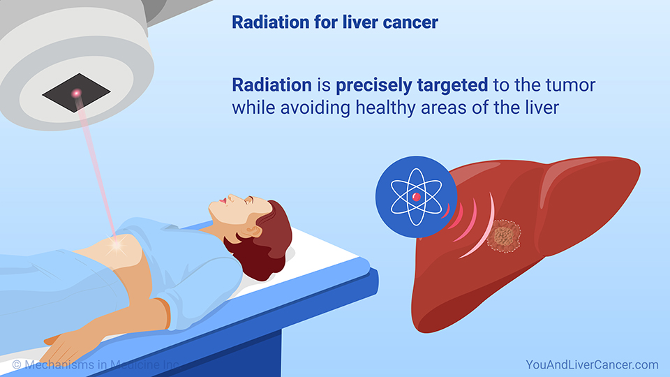 Radiation for liver cancer