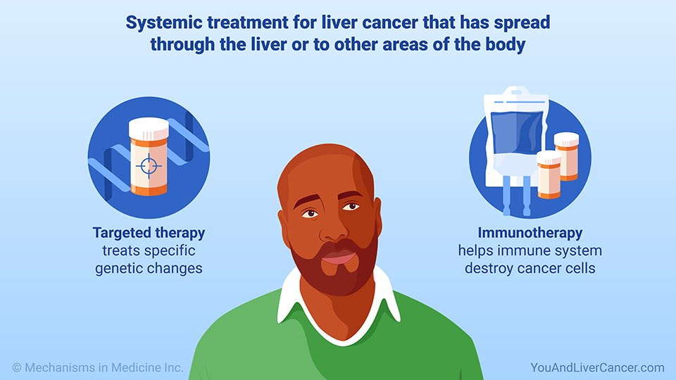 Systemic treatment for liver cancer that has spread through the liver or to other areas of the body