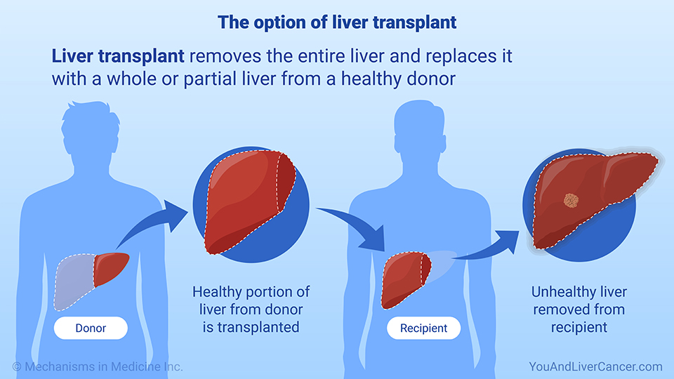 The option of liver transplant