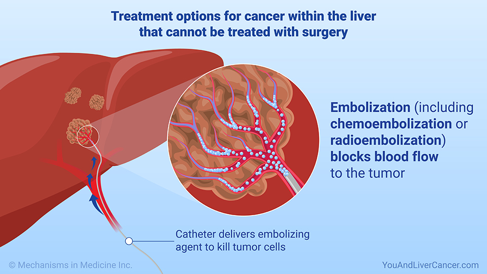 Treatment options for cancer within the liver that cannot be treated with surgery 