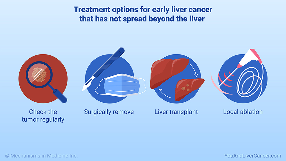 Treatment options for early liver cancer that has not spread beyond the liver 