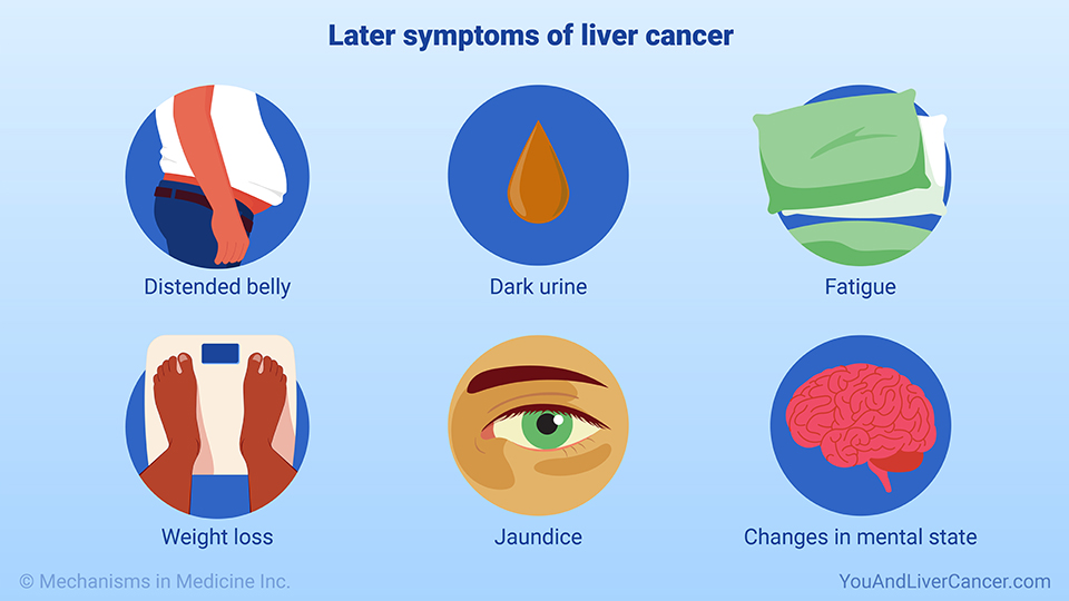 Later symptoms of liver cancer 