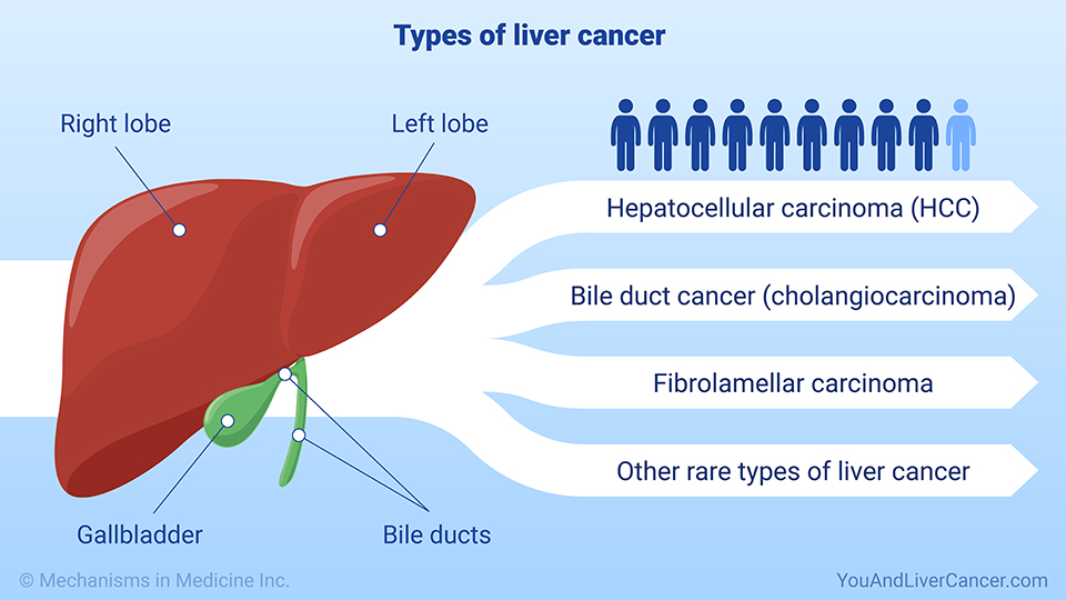 Types of liver cancer